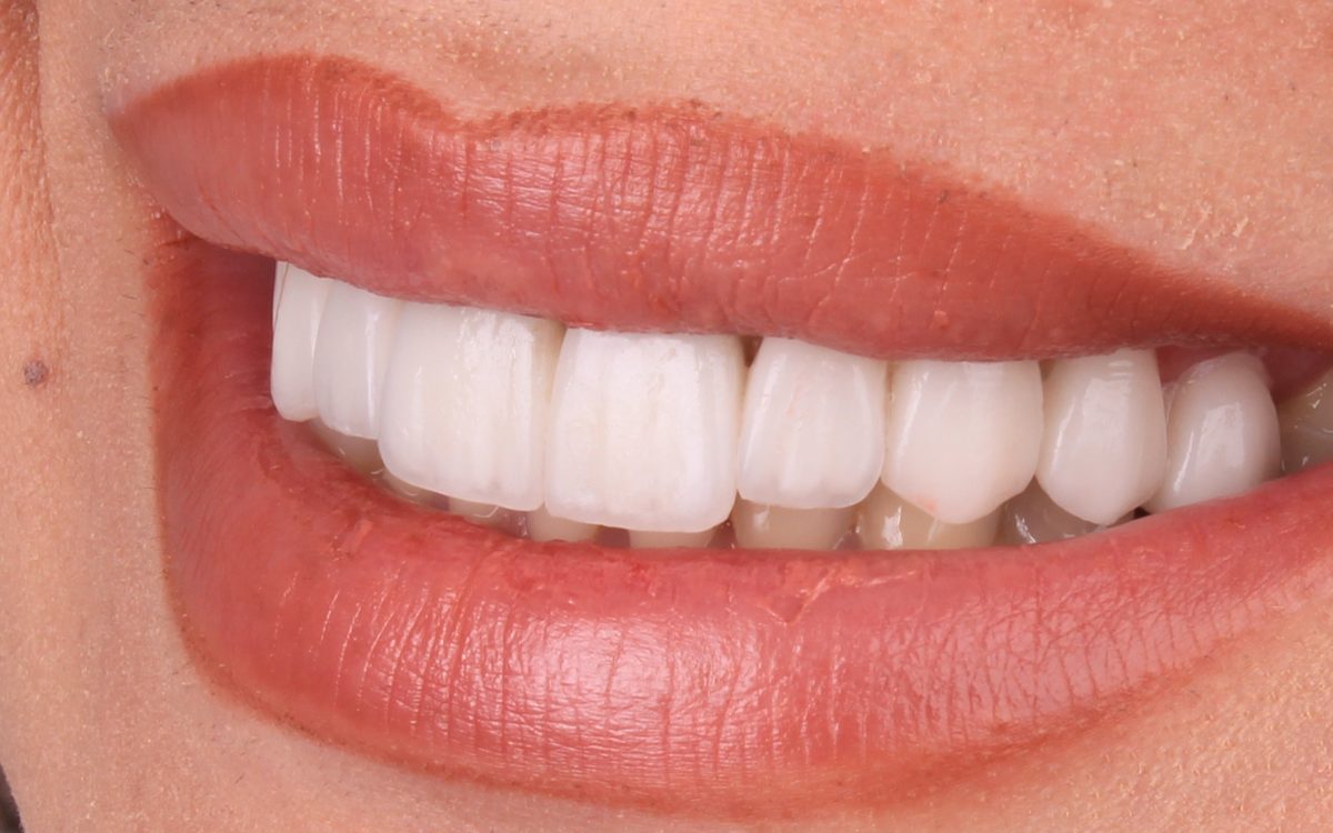 After: even, bright white upper teeth, side view