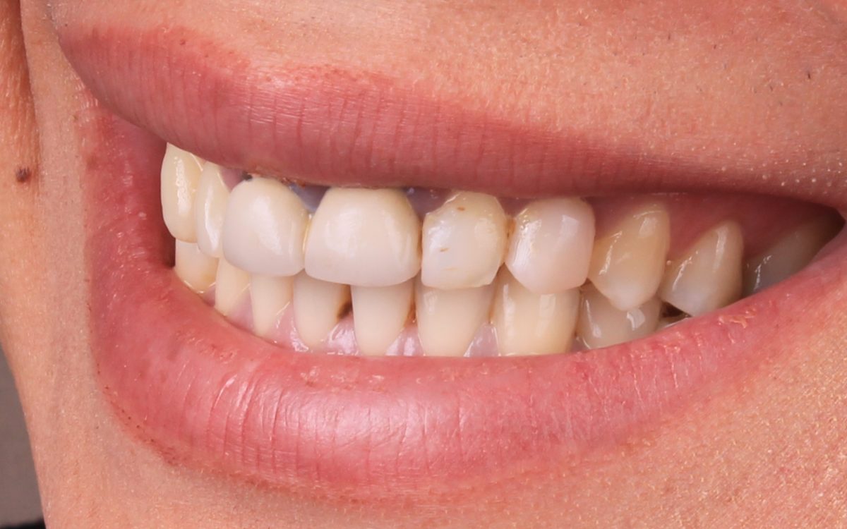 Before: crowded, uneven, yellowed front teeth, side view
