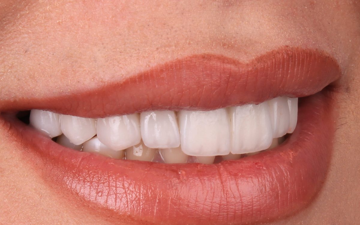 After: even, bright white upper teeth, opposite side view