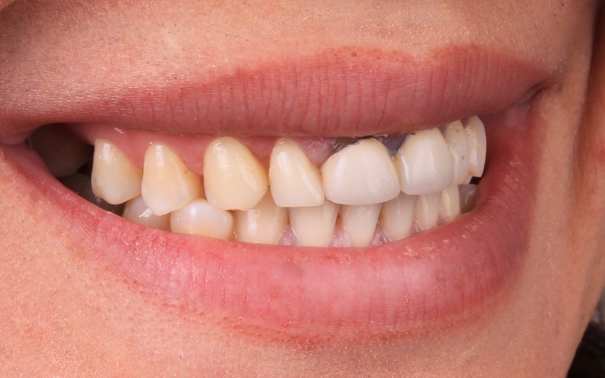 Before: yellowed, uneven upper teeth with a dark gap, opposite side view