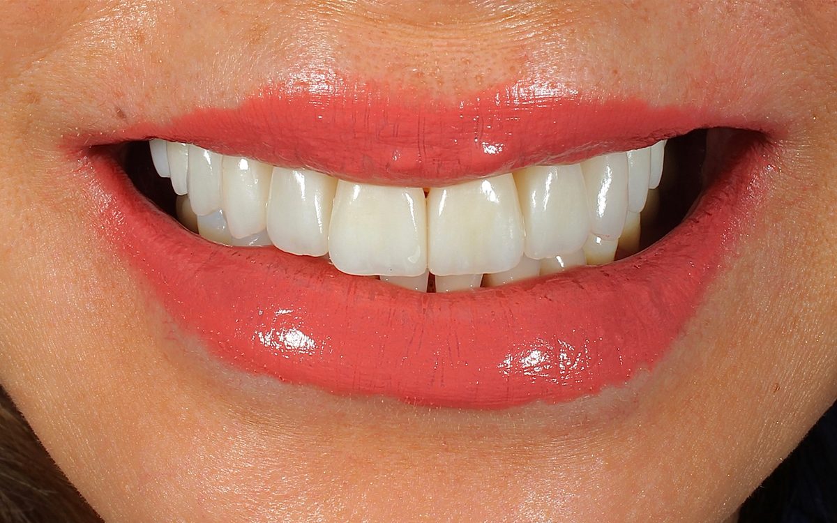 After: even, evenly colored front teeth with smooth edges, front view