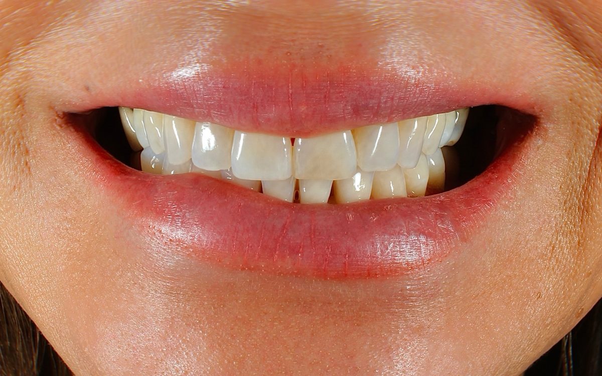 Before: slightly crowded front teeth with uneven edges and one darker front tooth, front view