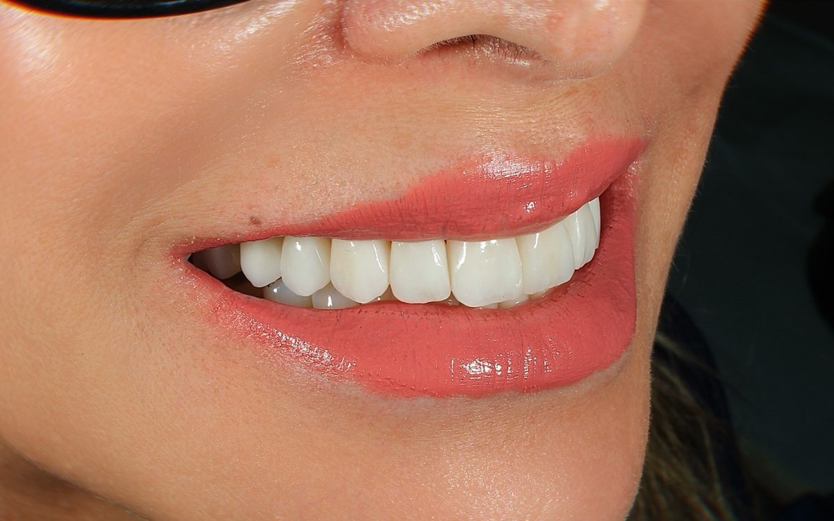 After: even, evenly colored front teeth, side view
