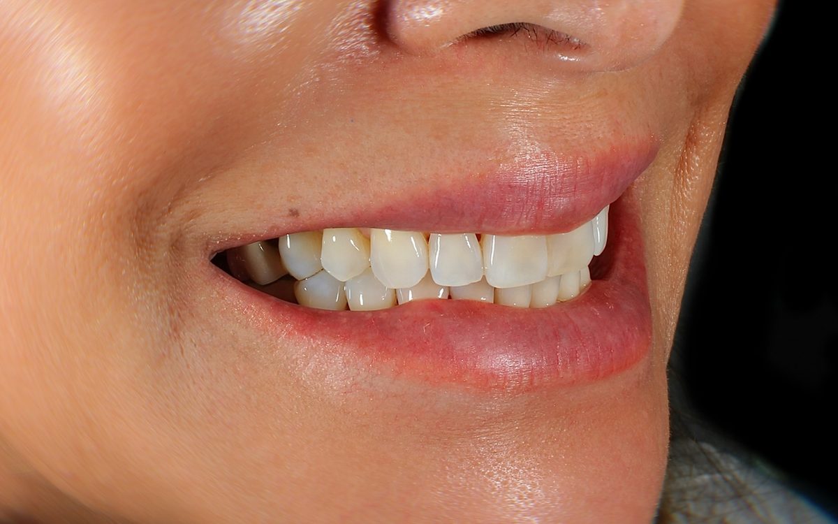 Before: uneven, slightly crowded front teeth, side view