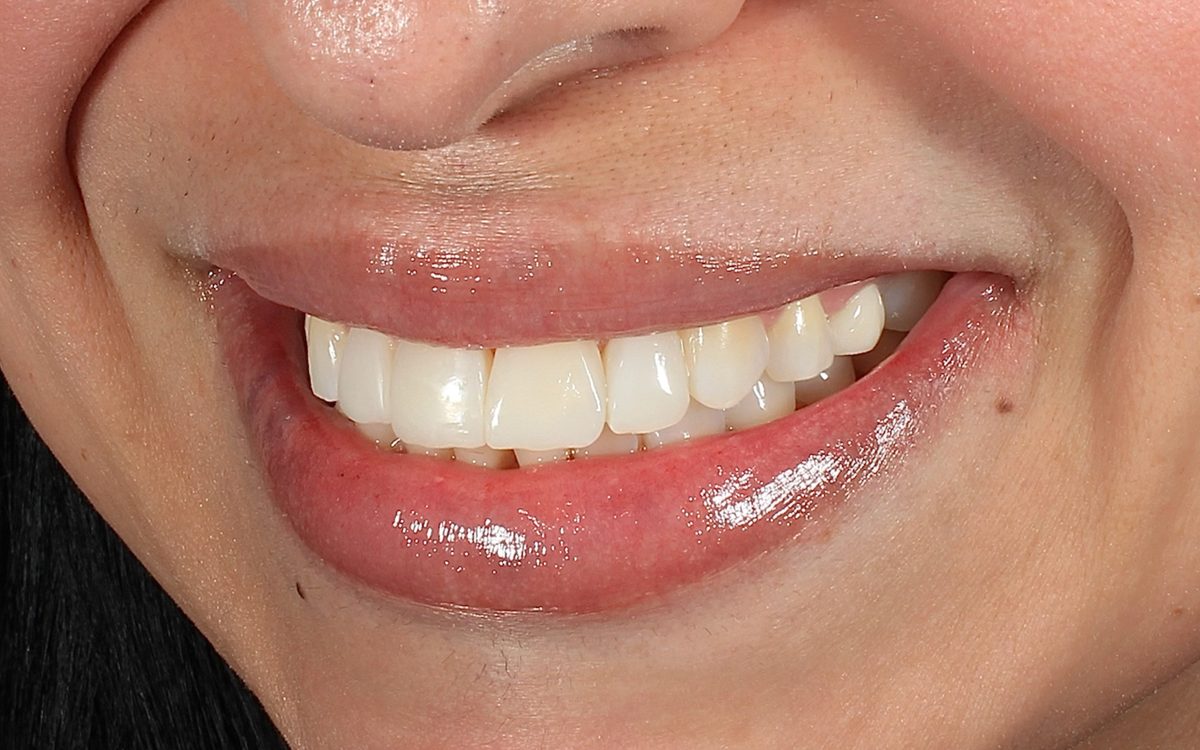 After: smooth, even front teeth, side view