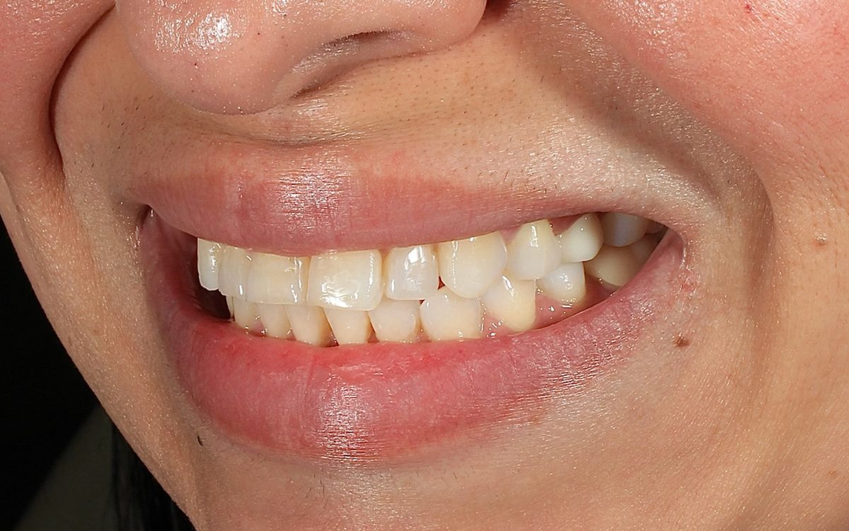 Before: uneven, overlapping front teeth, side view