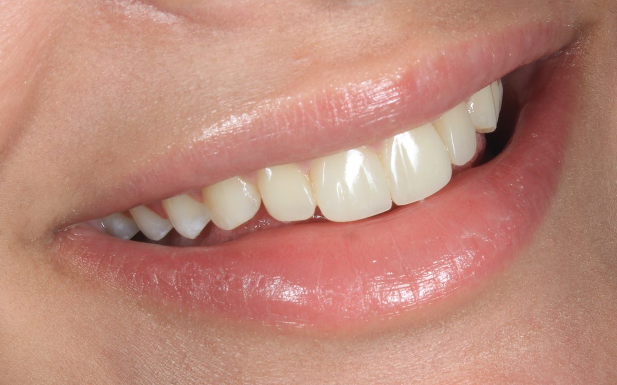After: even, evenly colored front teeth with smooth edges, side view