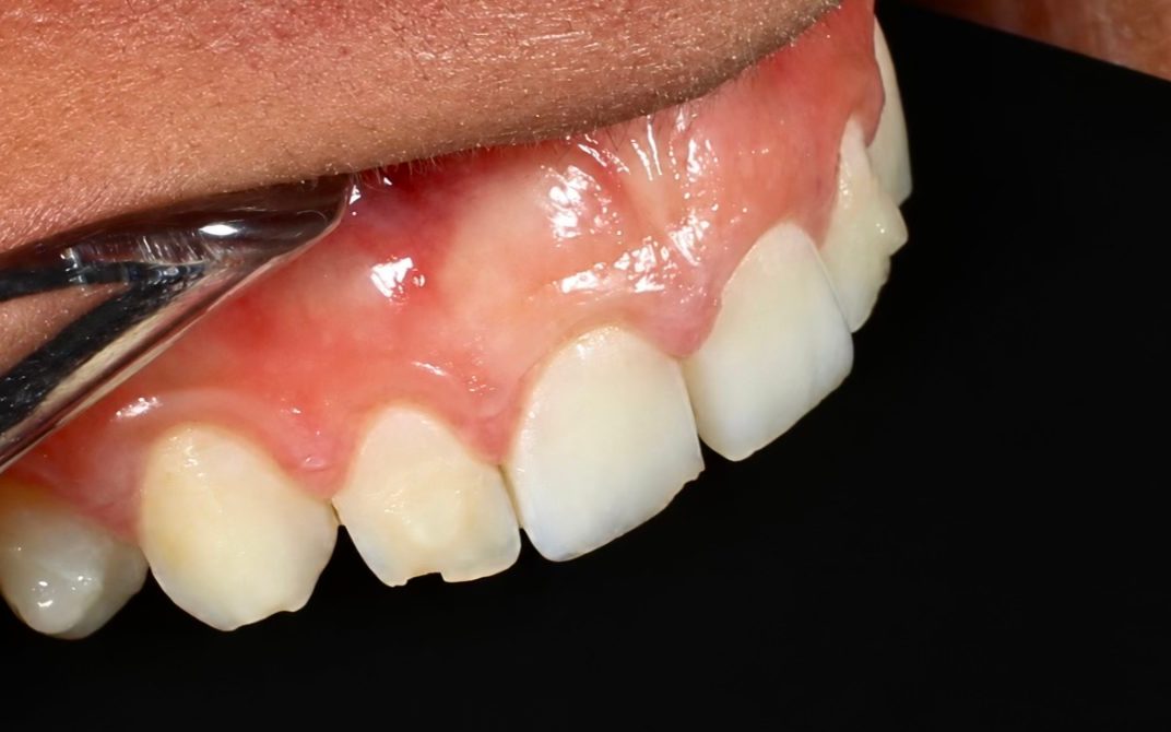 Before: close-up of upper front teeth with chipped and worn edges